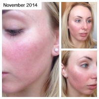 My Acne Journey: Update